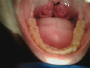 tonsil1